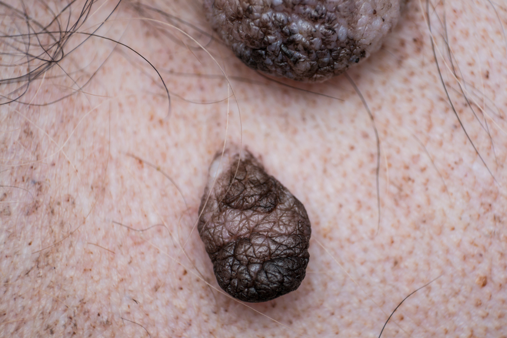 Close-up of two large, darker growths on the skin with hair and freckles, examined by a veterinarian. The growths appear textured and raised, with irregular shapes and surfaces. The background skin is light with visible pores and hair.